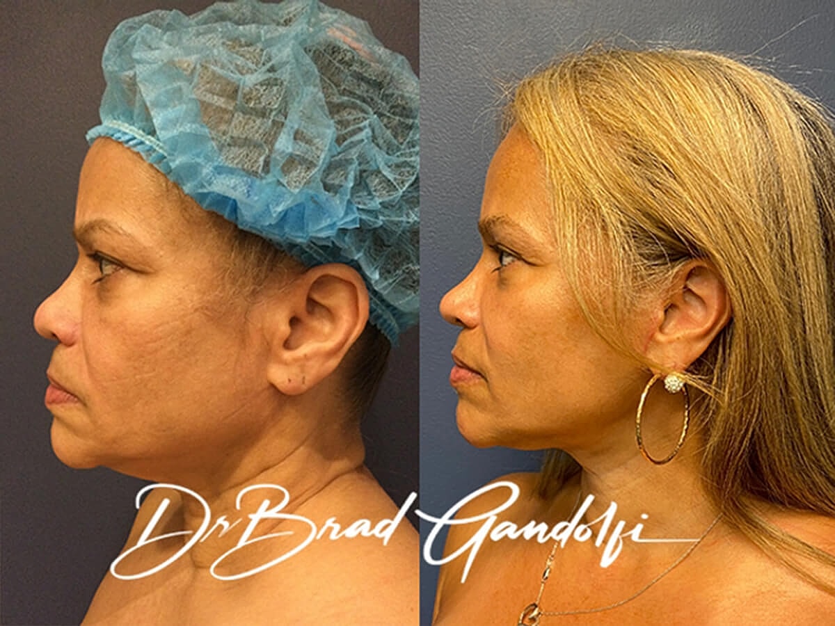 Facelift Before & After