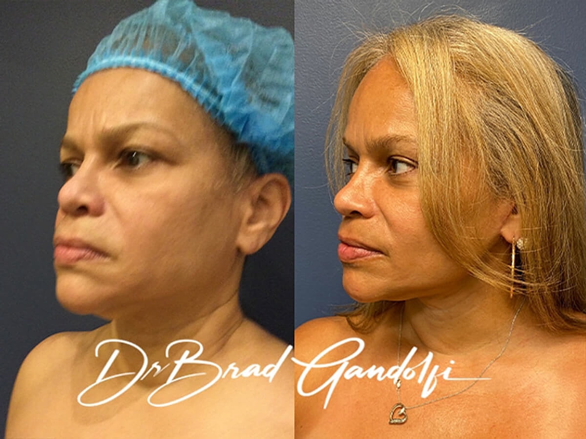 Facelift Before & After