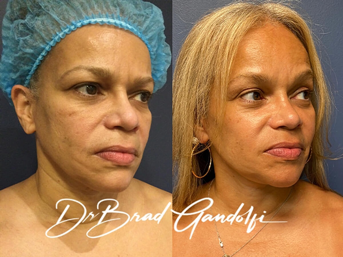 Facelift Before & After