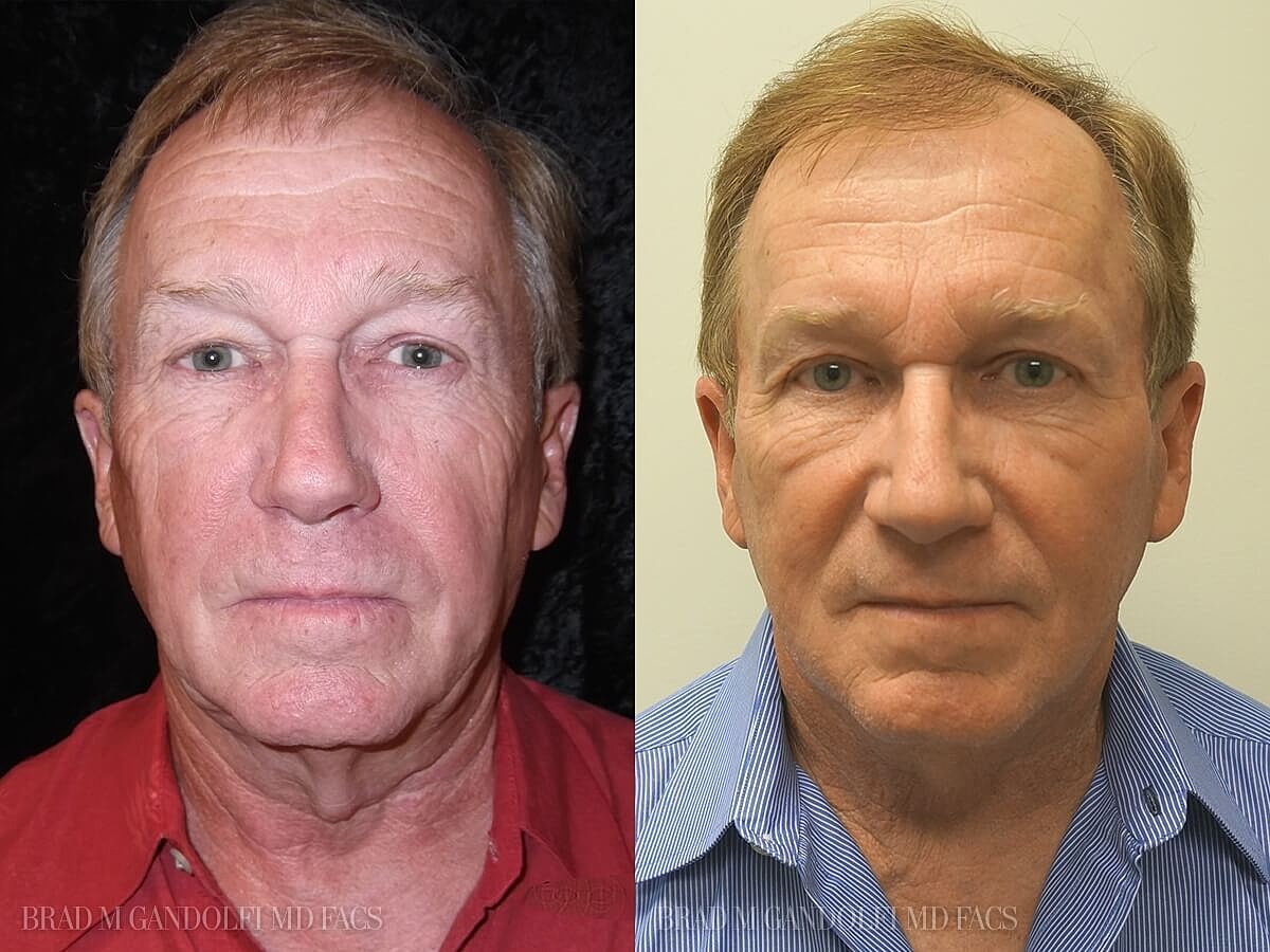 Facelift Before & After