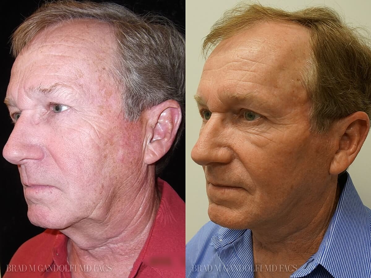 Facelift Before & After