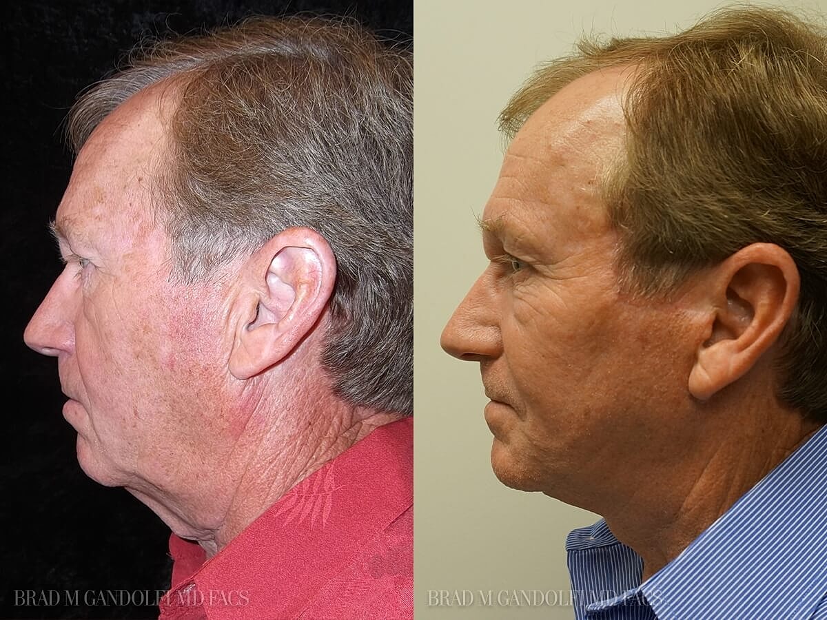 Facelift Before & After