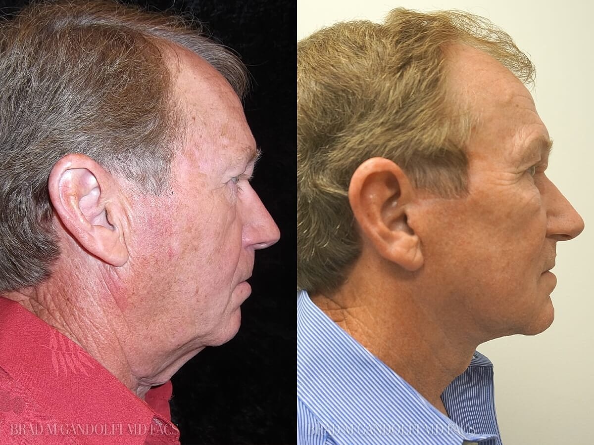 Facelift Before & After