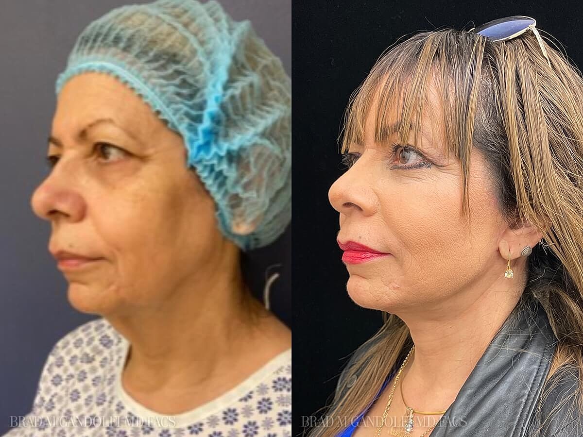 Facelift Before & After