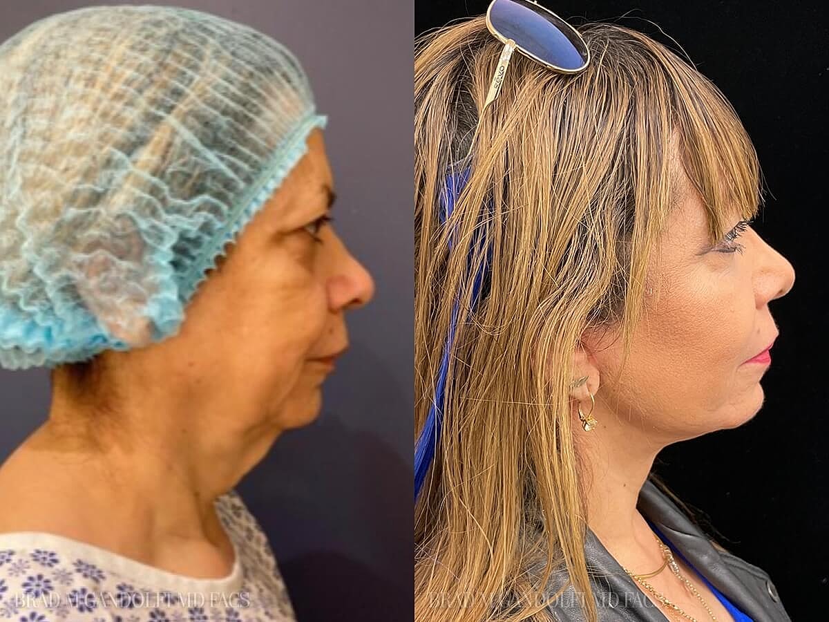 Facelift Before & After