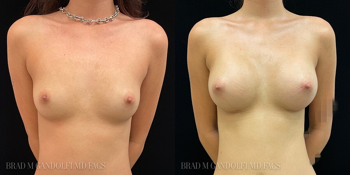 Breast Augmentation Before & After