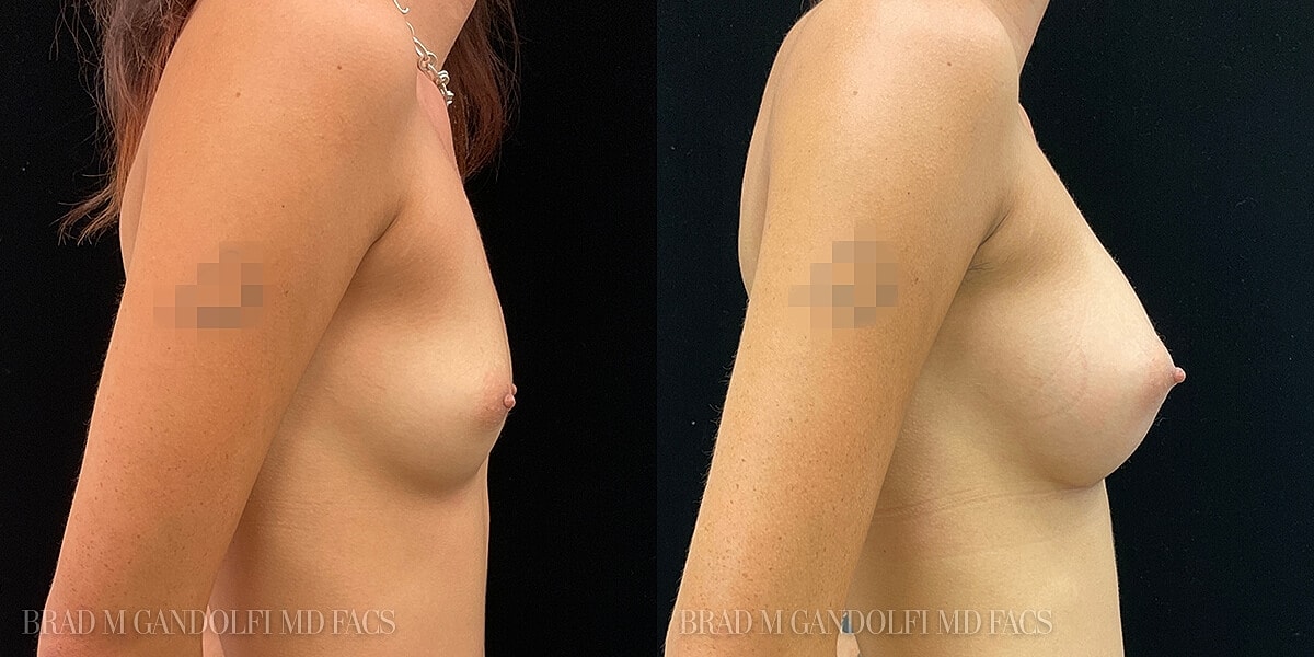 Breast Augmentation Before & After