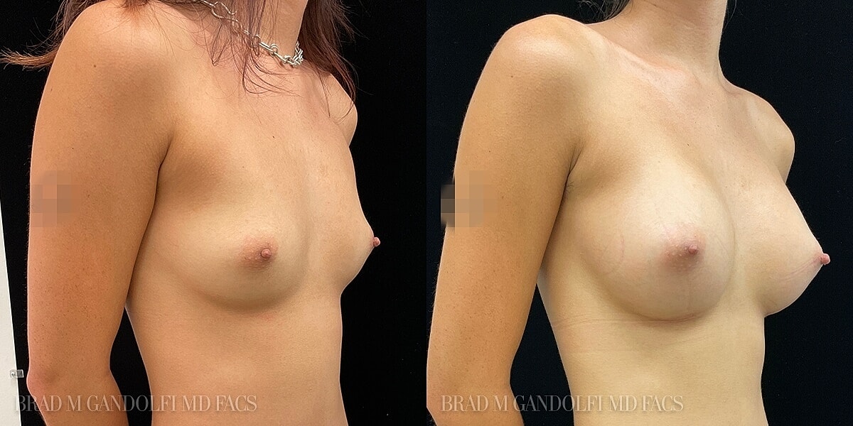 Breast Augmentation Before & After