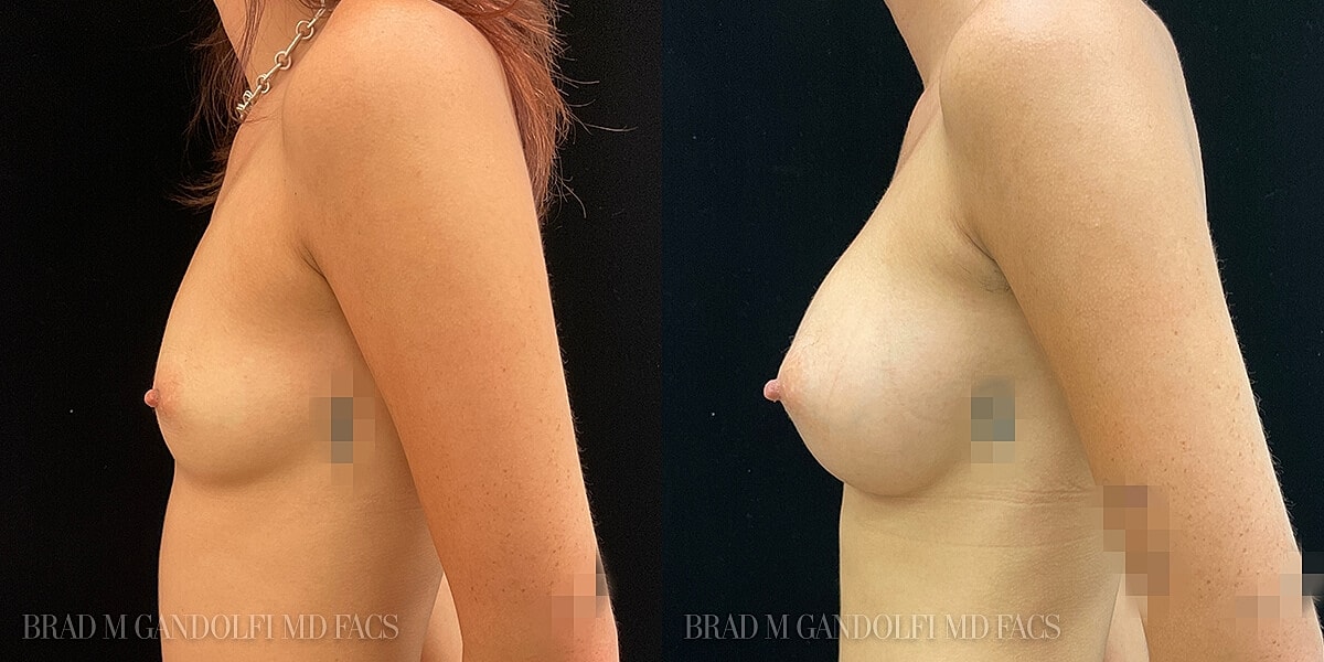 Breast Augmentation Before & After