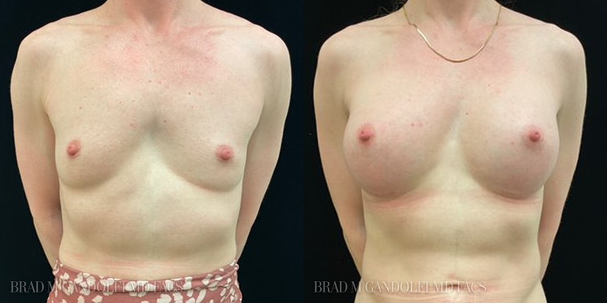 Breast Augmentation Before & After
