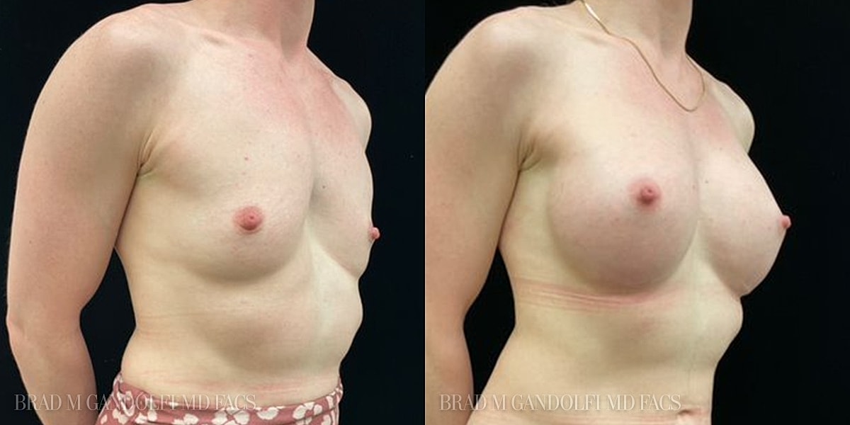 Breast Augmentation Before & After