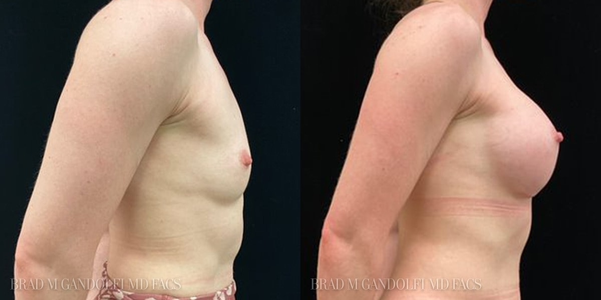 Breast Augmentation Before & After