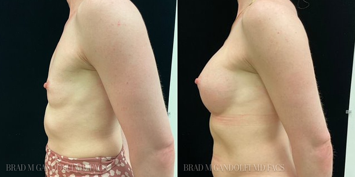 Breast Augmentation Before & After