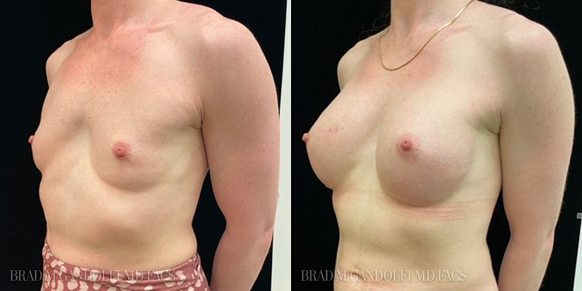 Breast Augmentation Before & After