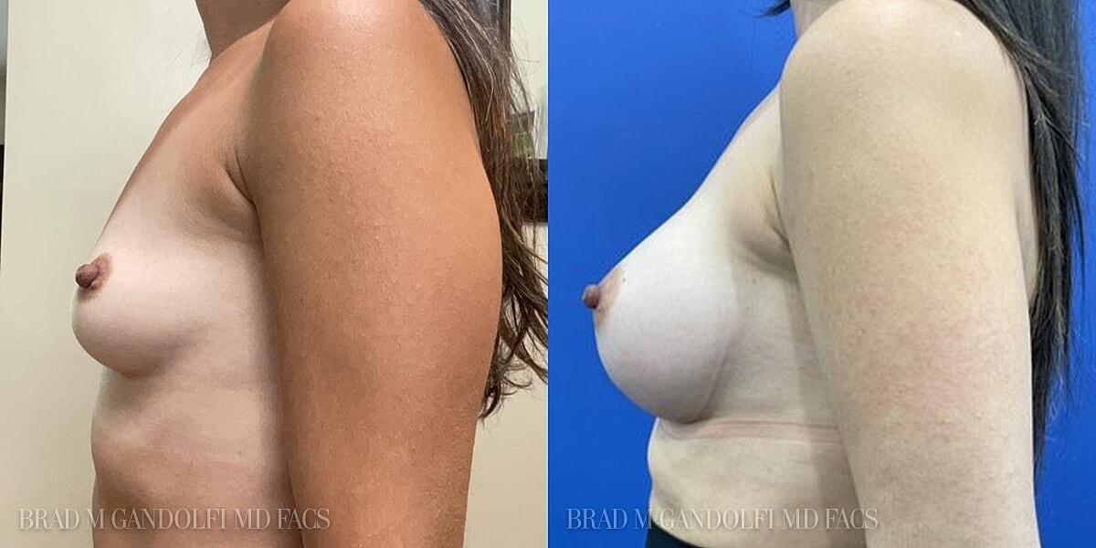 Breast Augmentation Before & After