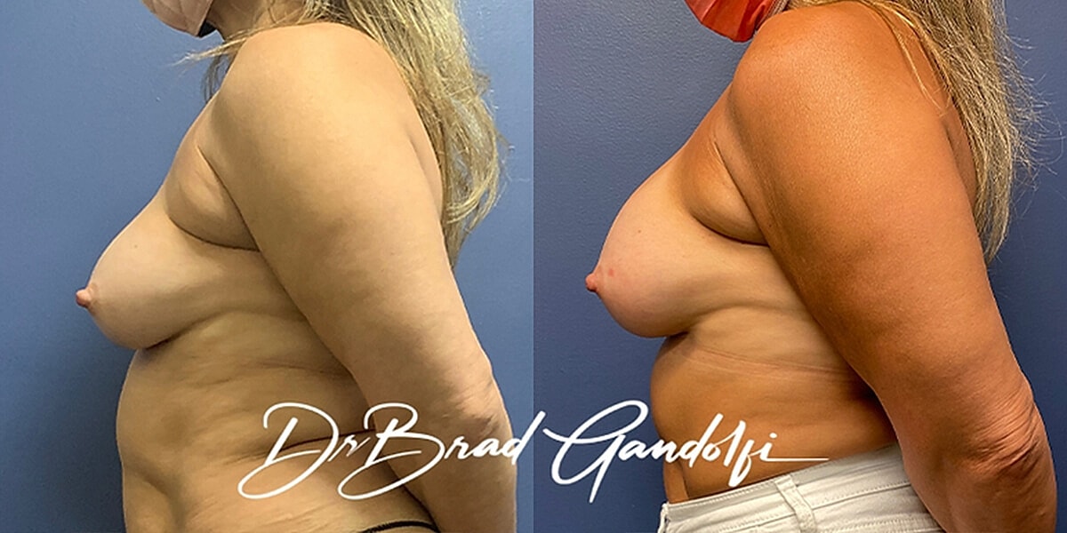 Breast Augmentation Before & After