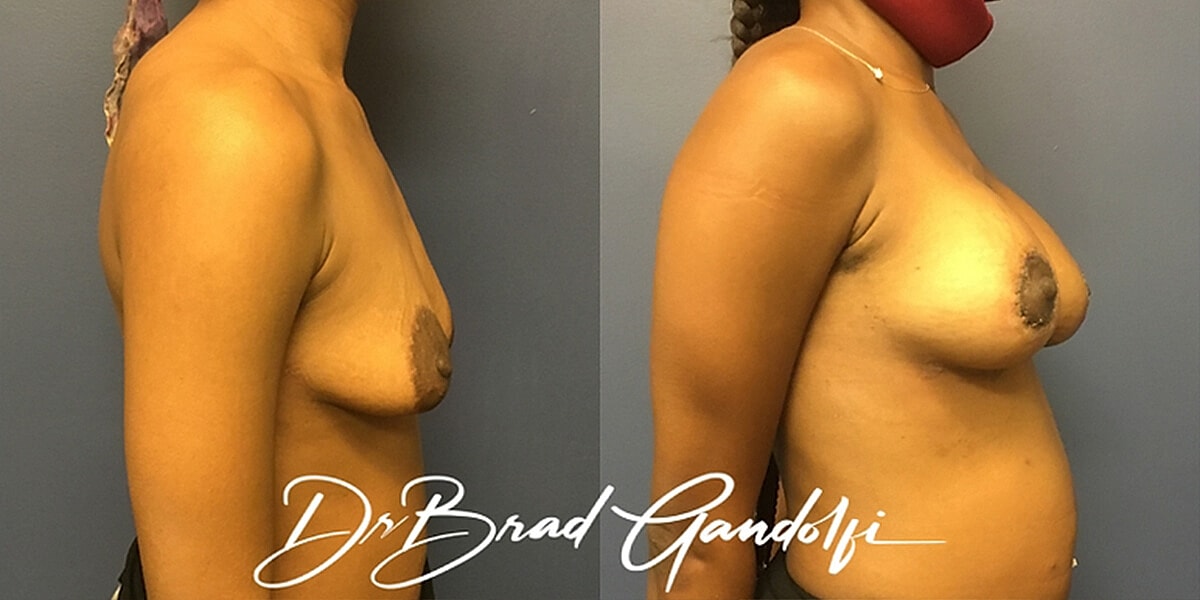 Breast Augmentation Before & After