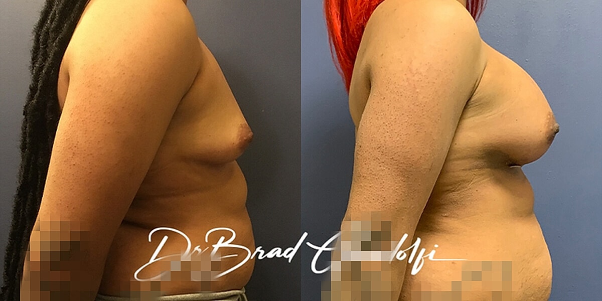 Breast Augmentation Before & After