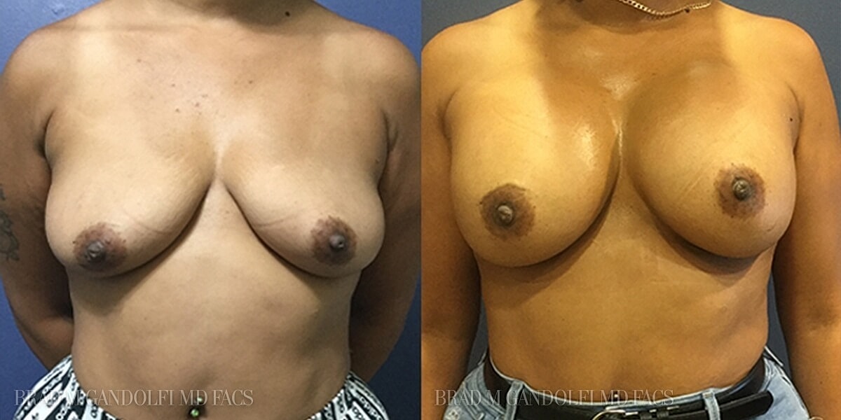 Breast Augmentation Before & After