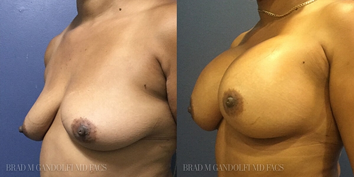 Breast Augmentation Before & After