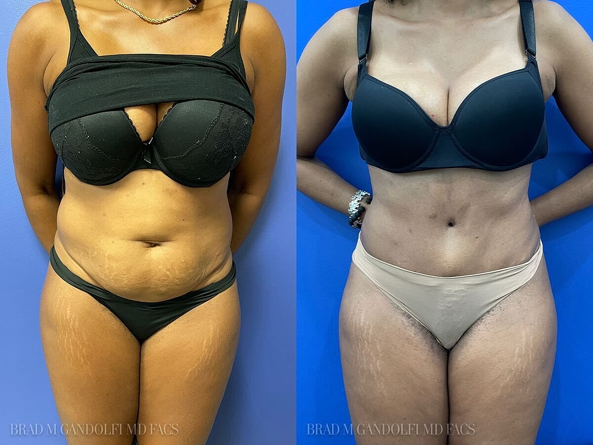 Tummy Tuck Before & After
