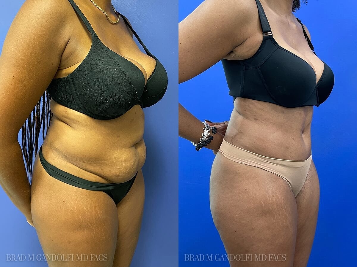 Tummy Tuck Before & After