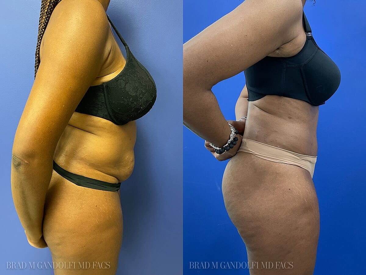 Tummy Tuck Before & After