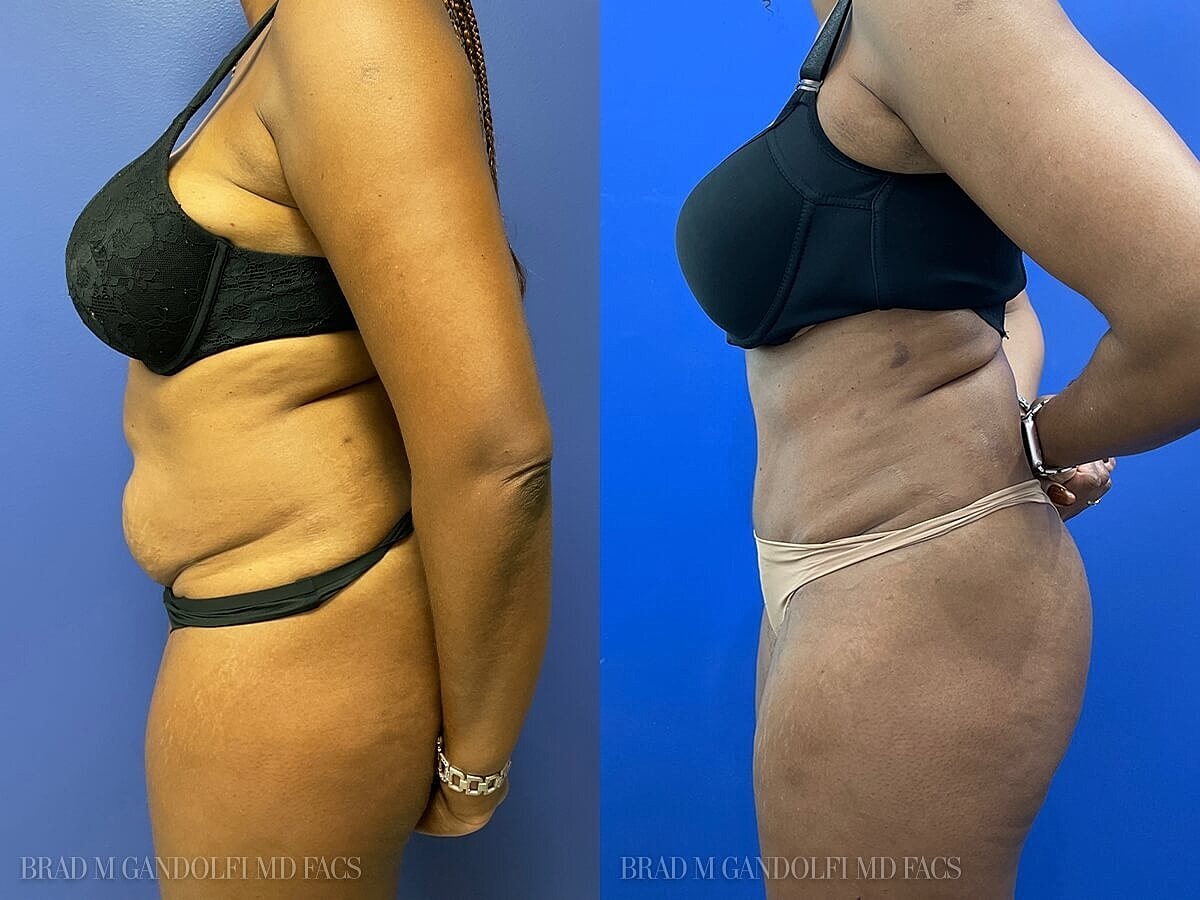 Tummy Tuck Before & After