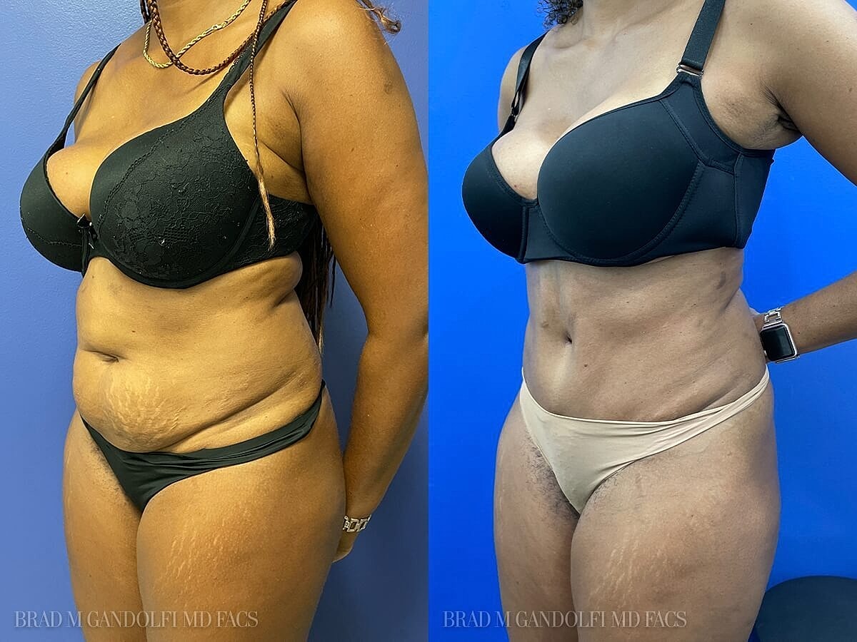Tummy Tuck Before & After