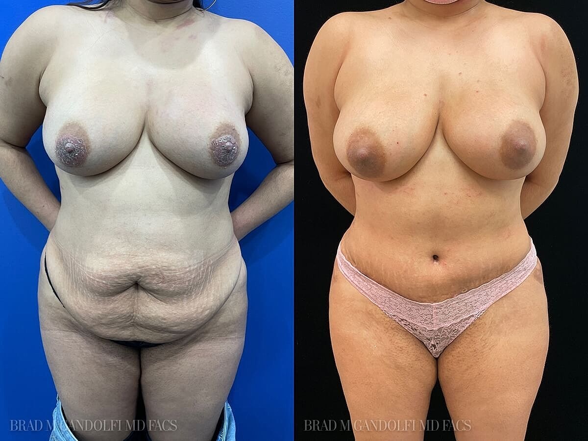 Tummy Tuck Before & After