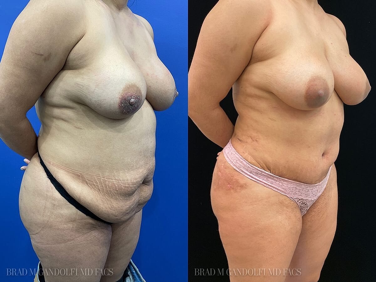 Tummy Tuck Before & After