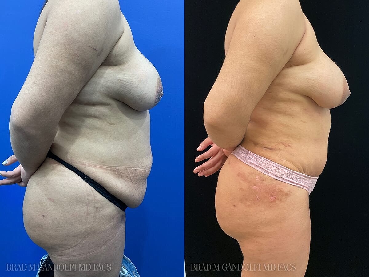 Tummy Tuck Before & After