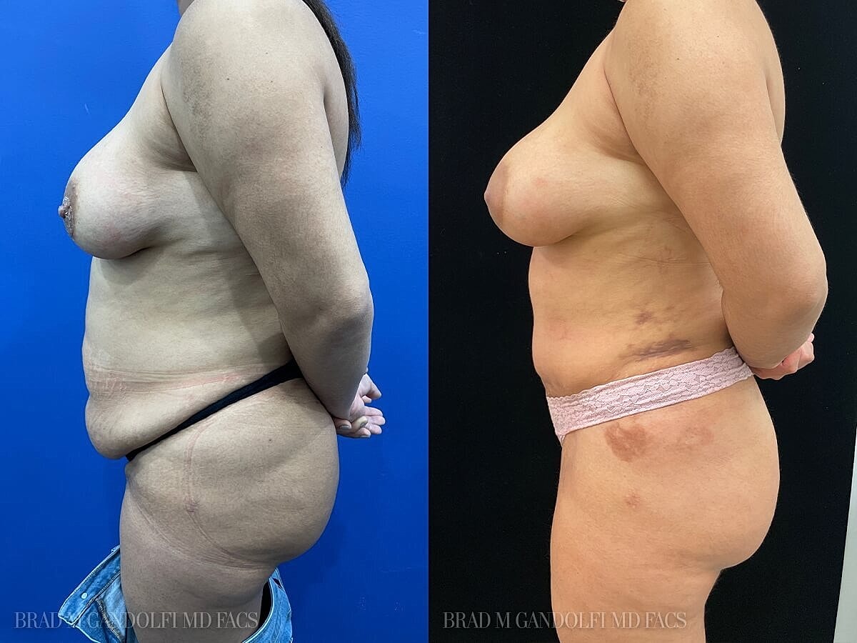 Tummy Tuck Before & After