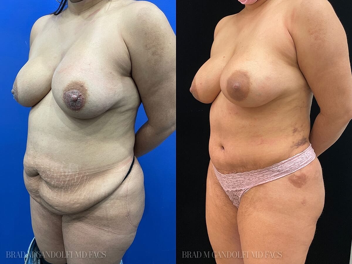 Tummy Tuck Before & After