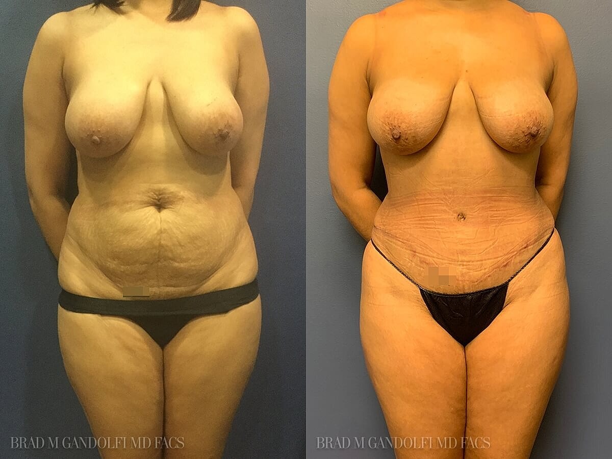 Tummy Tuck Before & After