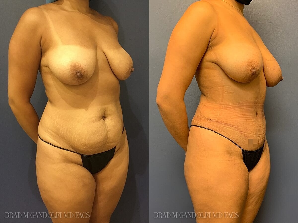 Tummy Tuck Before & After