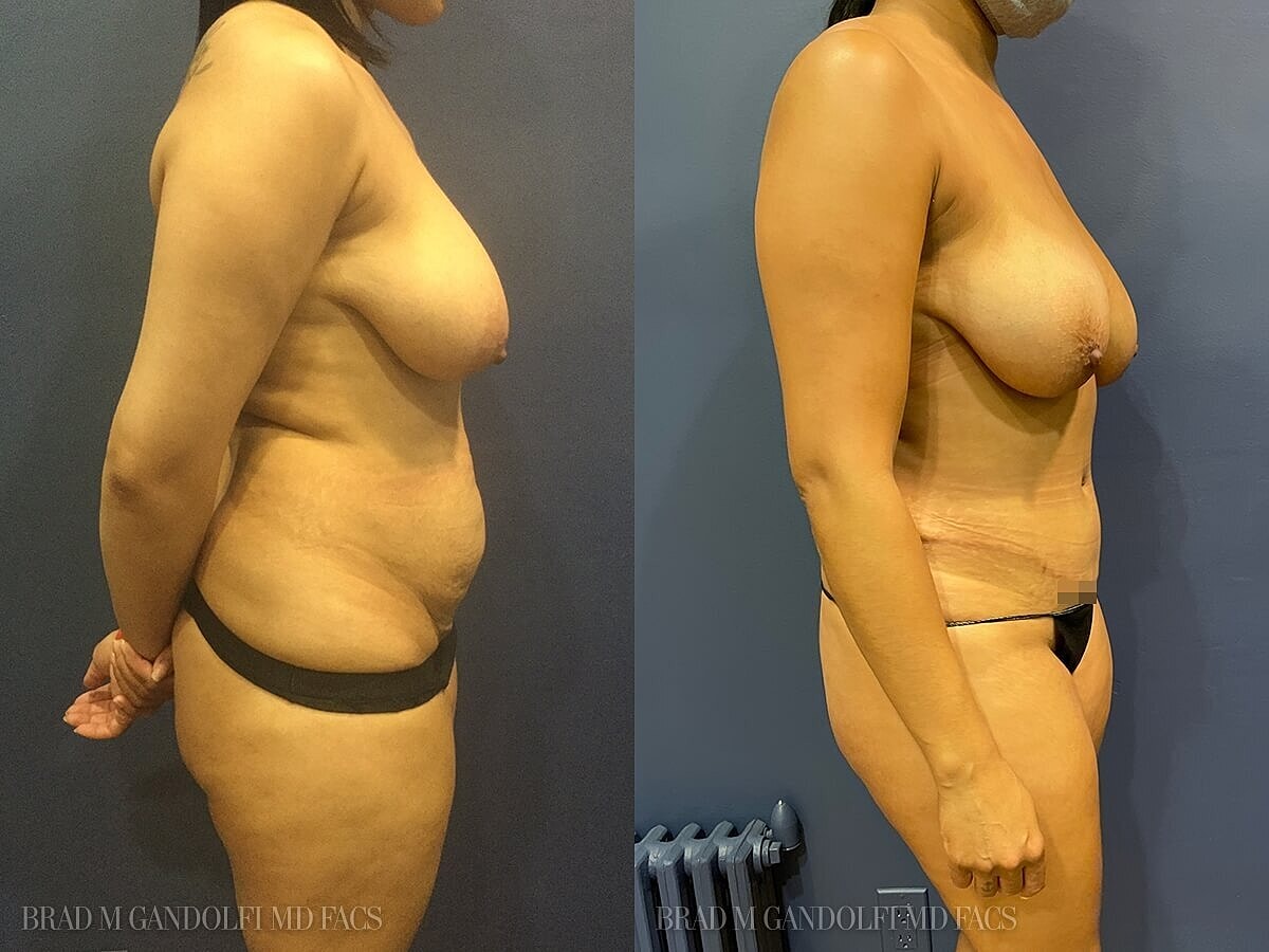 Tummy Tuck Before & After