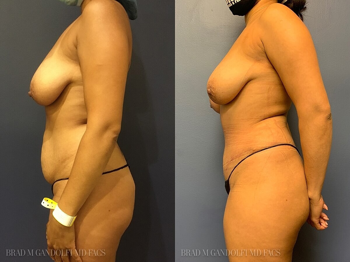 Tummy Tuck Before & After