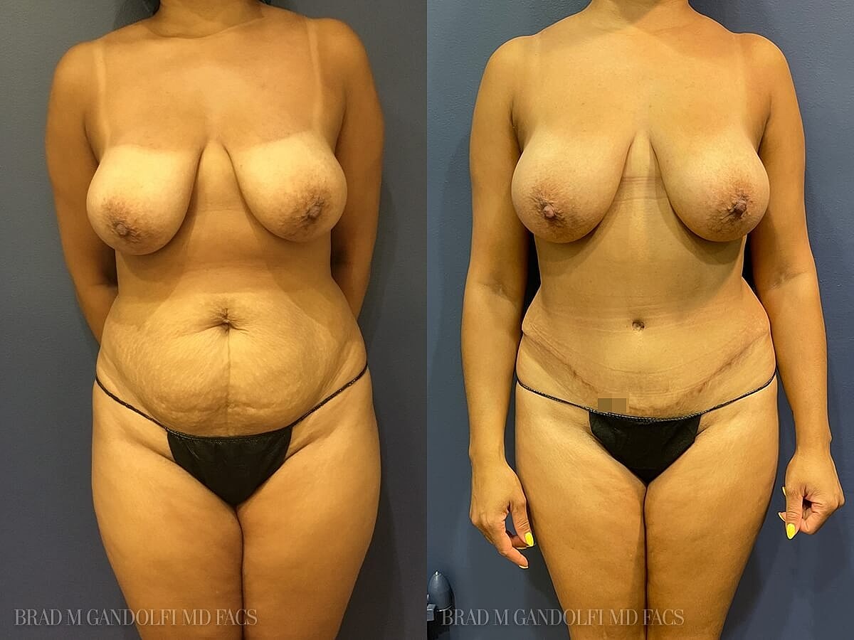 Tummy Tuck Before & After