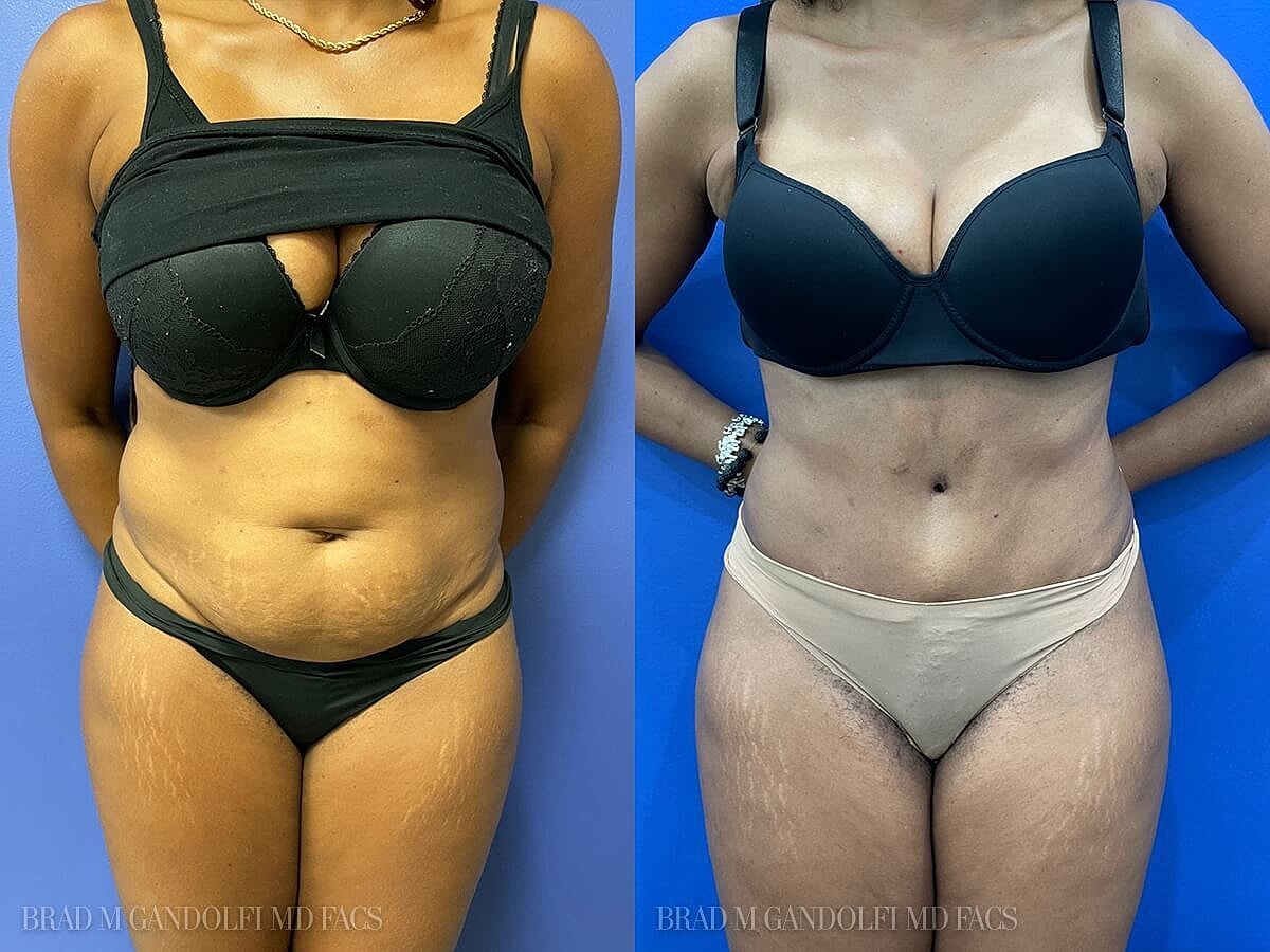 Tummy Tuck Before & After
