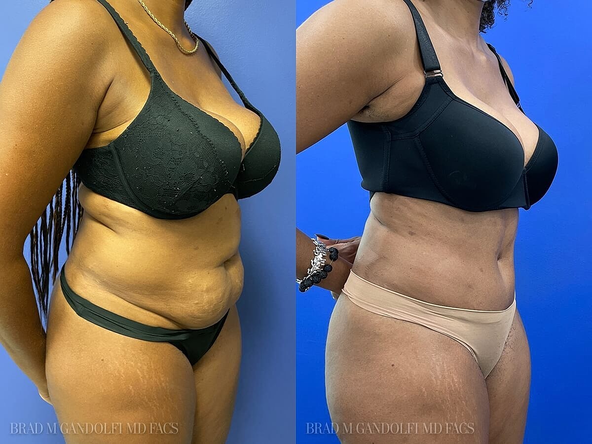 Tummy Tuck Before & After