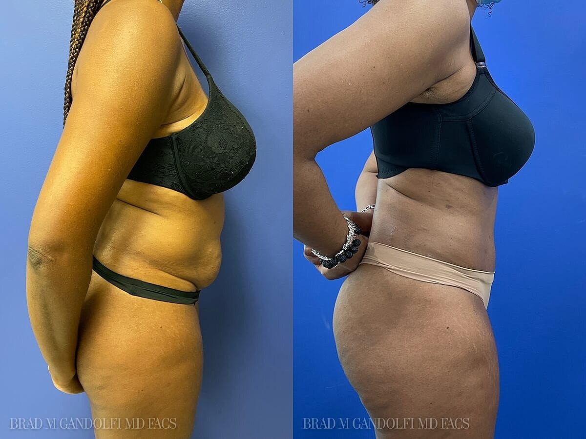 Tummy Tuck Before & After