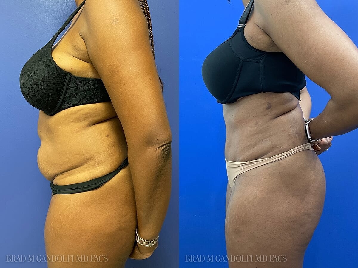 Tummy Tuck Before & After