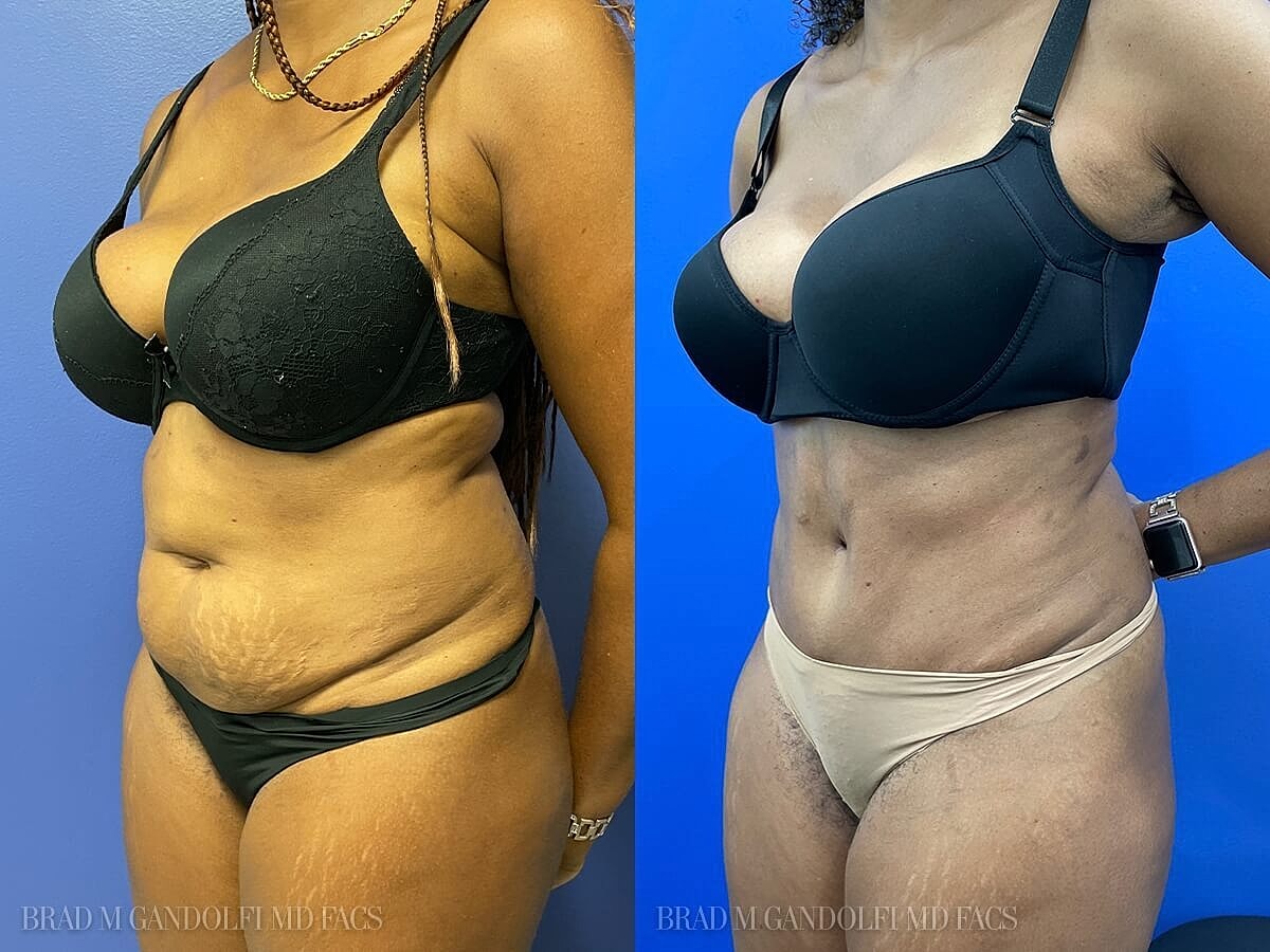 Tummy Tuck Before & After