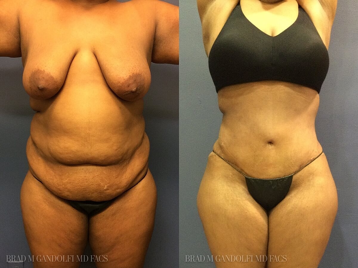 Tummy Tuck Before & After
