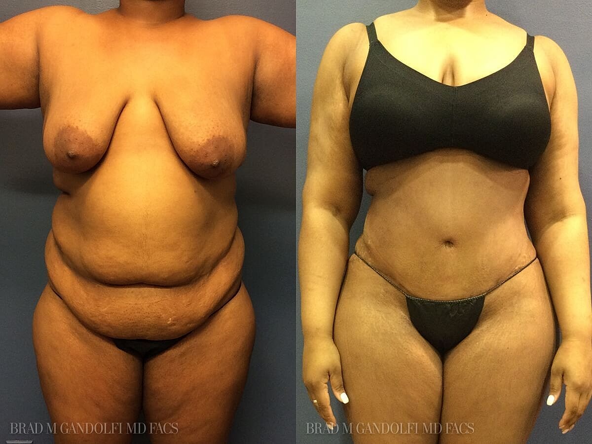 Tummy Tuck Before & After