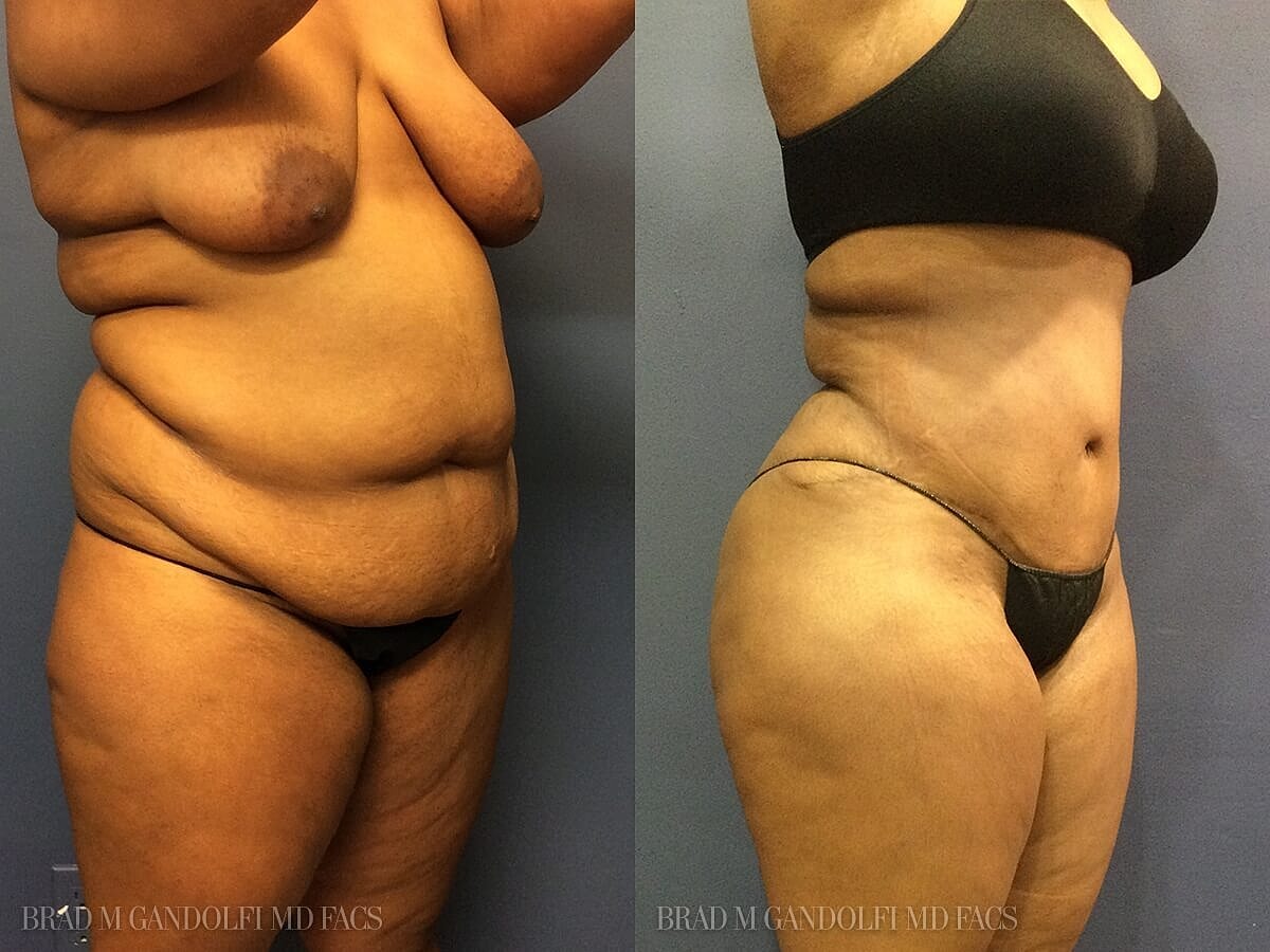 Tummy Tuck Before & After