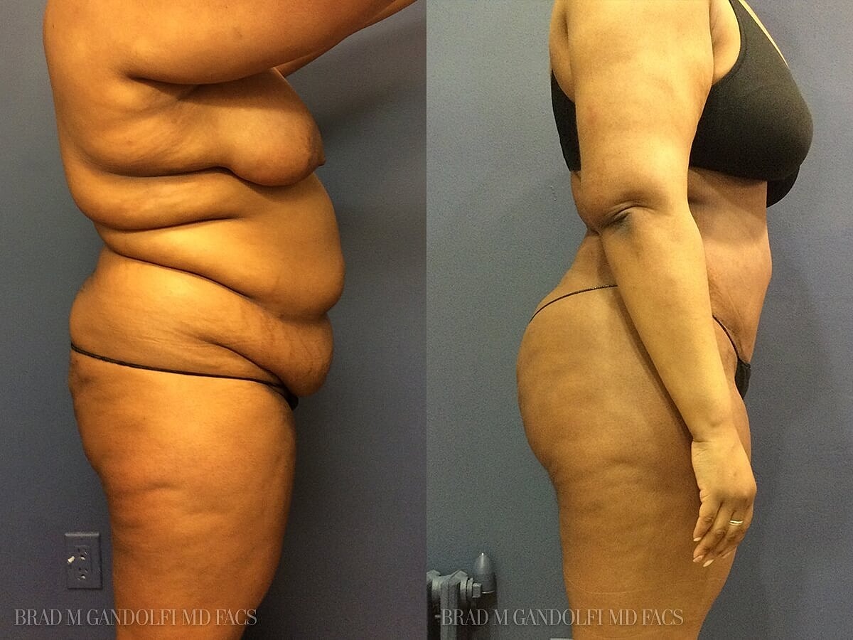 Tummy Tuck Before & After