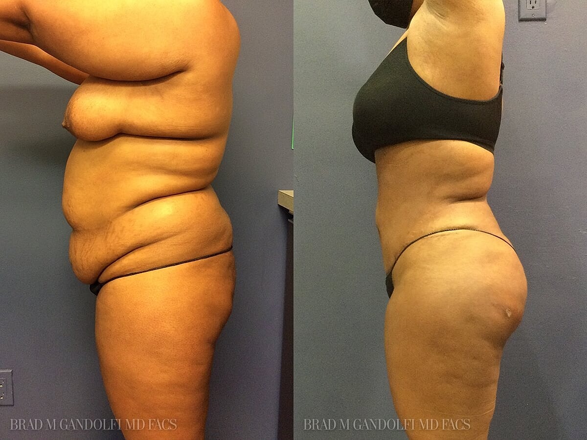 Tummy Tuck Before & After