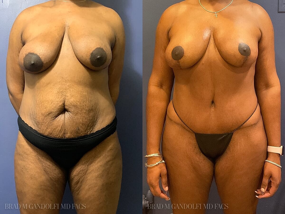 Tummy Tuck Before & After